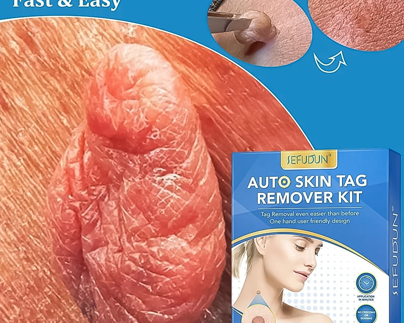 Skin Tag Remover