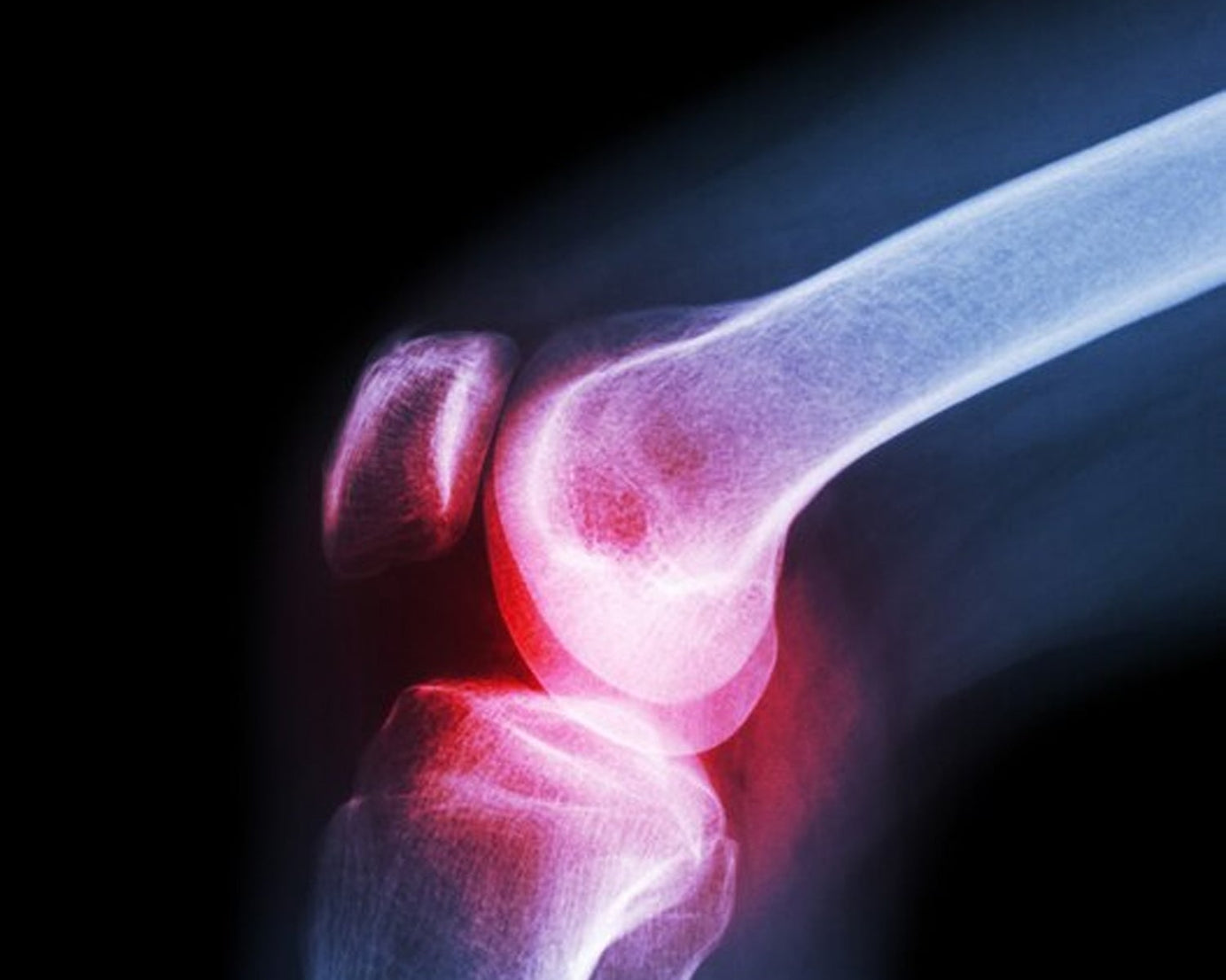 Large knee cap, enhances comfort and stability